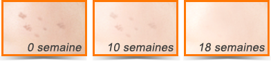 Leau oxygénée pour la personne des taches de rousseur